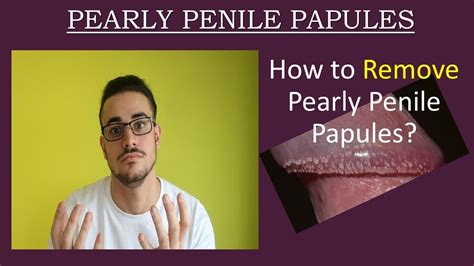 papule penienne|Pearly Penile Papules: White Spots on Penis